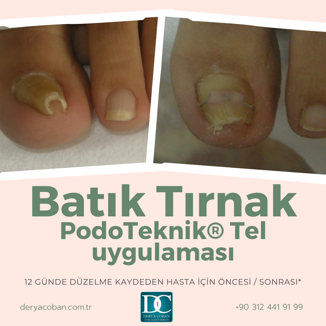 Batık tırnak